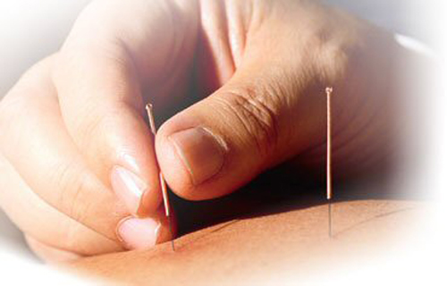 About Acupuncture