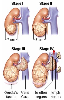 stages of kidney cancer