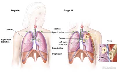 Get Information About Lung Cancer
